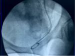 Stent Allium en uréter distal seccionado